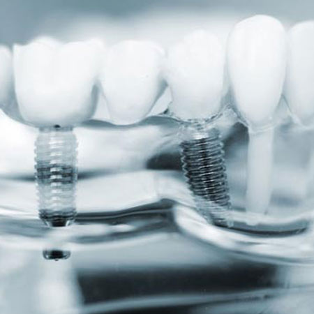 Zahnimplantate Koblenz